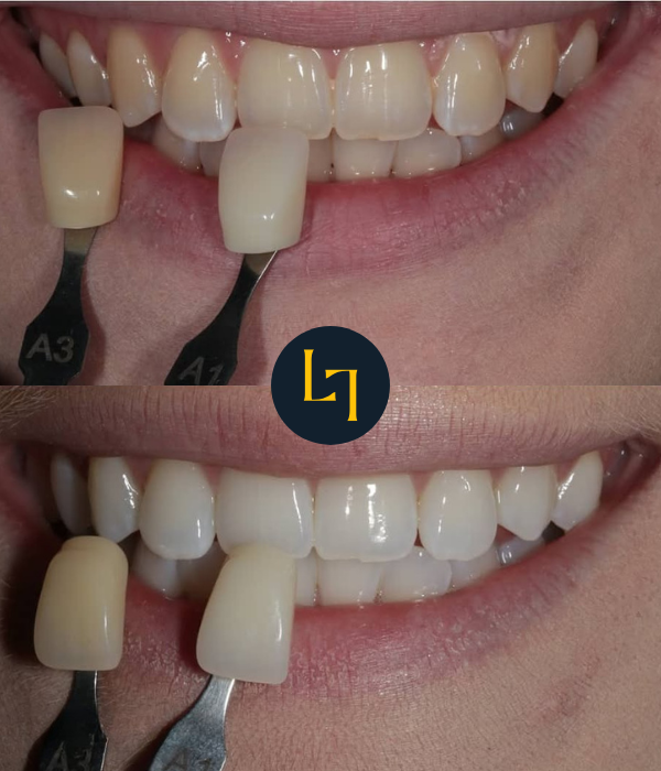 before and after teeth whitening in Sheffield - top half showing yellowish teeth while the bottom part showing whiter teeth after treatment - patient 1